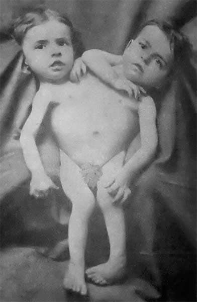 Близнецы-дицефалы Джованни и Джакомо Точчи (Tocci) из Локаны (Италия), 1881